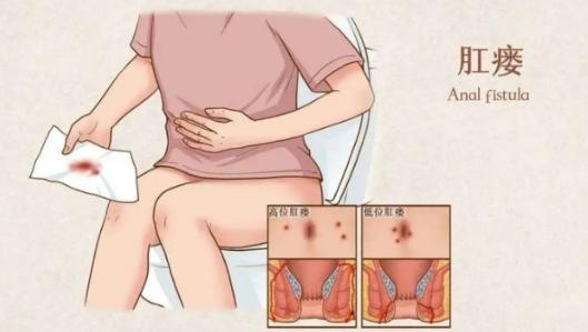 屁股上长火疖子和肛瘘的区别,屁股长脓疮是热毒还是什么