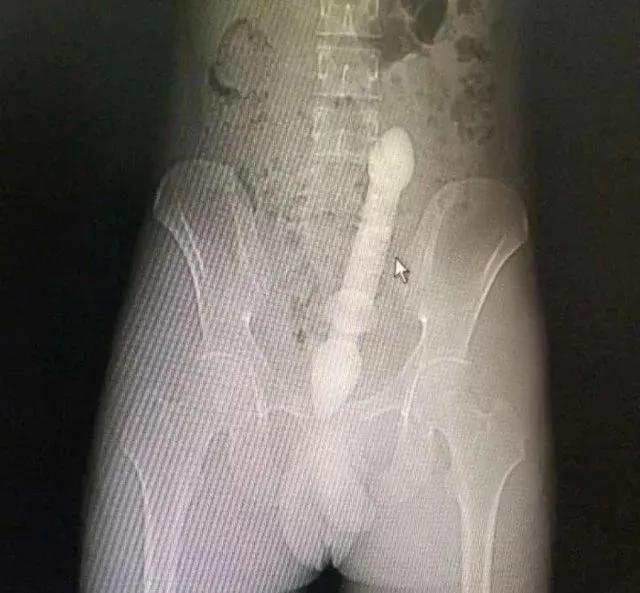 罗非鱼塞进直肠多长时间,星医百可以长期吃吗