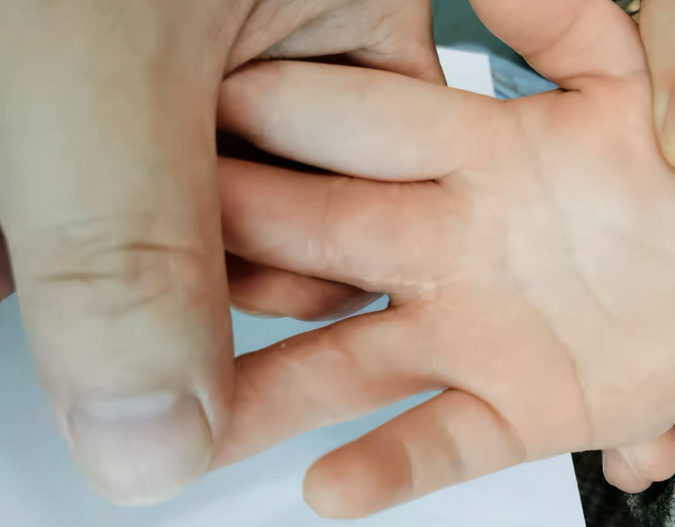 并指畸形免植皮案例,并指畸形