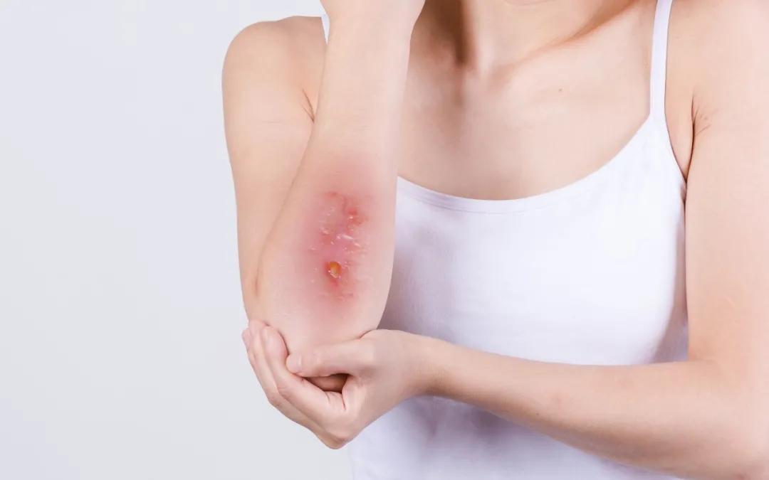 十大活血化瘀精油,活血精油推荐