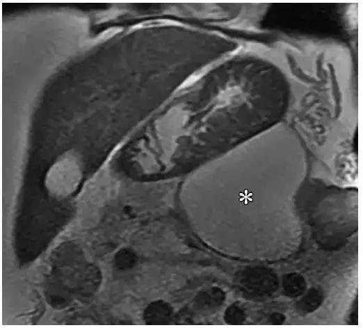 简述急性胰腺炎影像学表现,有关急性胰腺炎疼痛的图片