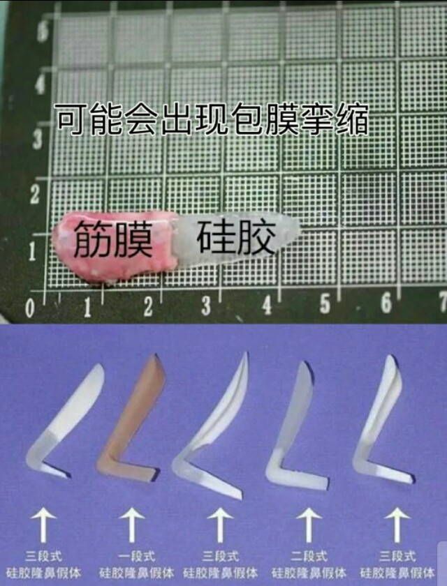 硅胶隆鼻会透光么,硅胶隆鼻会出现骨吸收的问题吗