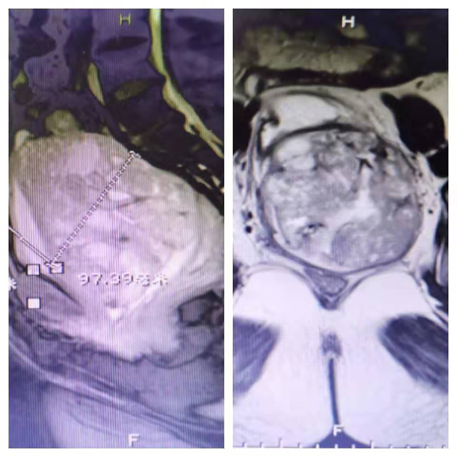 不放弃！为参加儿子婚礼，她坚持抗癌4年重获生机（真实感人）