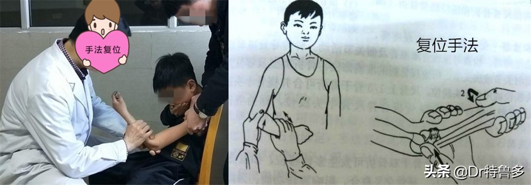 桡骨小头半脱位内旋外旋区别,桡骨小头半脱位复位收费标准