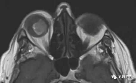 头部t1wi信号不均匀增高,脑t1wi和t2wi稍低信号