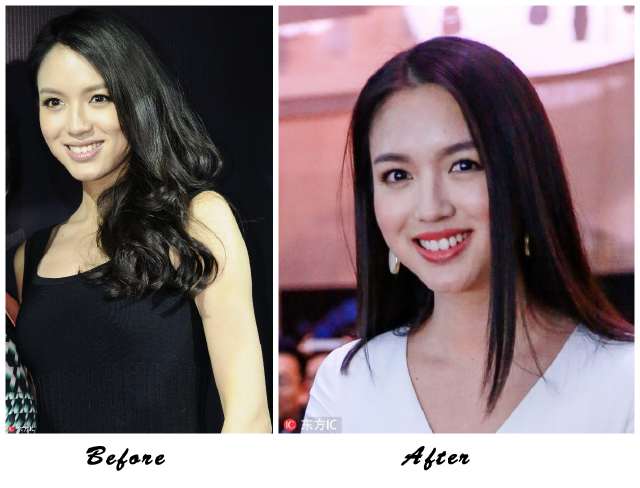 阿娇大龅牙,阿娇整牙