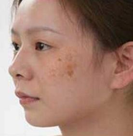 女人脸上有斑吃什么药可以祛斑,脸上长斑吃什么中药调理祛斑