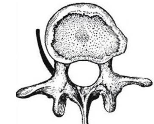 膨出型突出型脱出型游离型分类,腰椎间盘膨出和腰间盘突出的区别