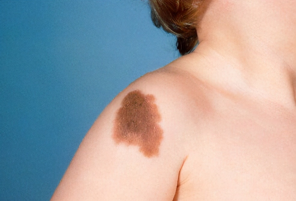 宝宝为什么出生后身上有很多青块,宝宝出生为什么有青胎记