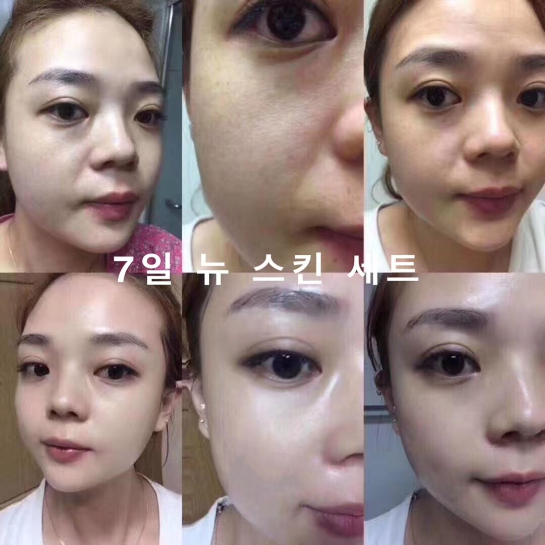 角质层增厚了皮肤好了,角质层健康