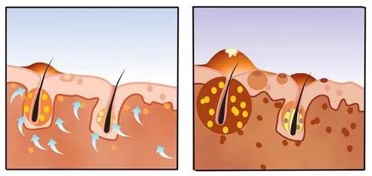 头皮长痘痘怎么办碰了痛,头皮长痘痘怎么办最有效的方法