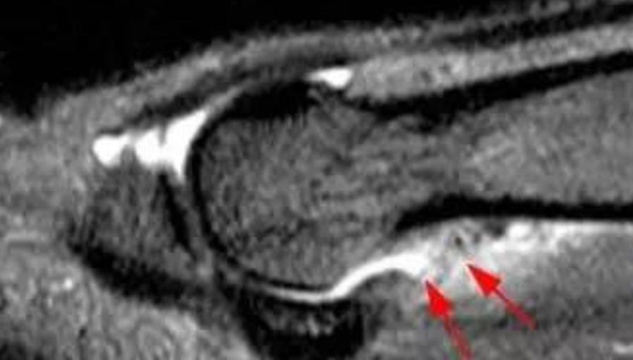 啥是草皮,啥叫草皮趾
