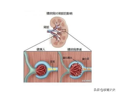 空腹血糖17.8糖化血红蛋白10,空腹血糖7.2尿蛋白2+怎么办