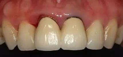 雅悦齿科烤瓷牙视频,雅悦齿科治疗费用