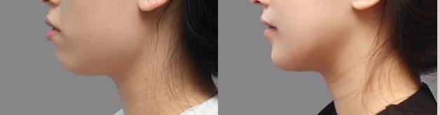 什么样的下巴才是最好看的,什么样的下巴是丰满的