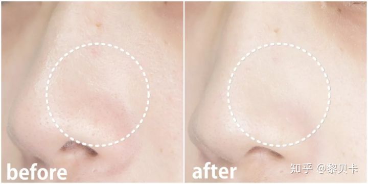 黑头去除神器排行榜,黑头粉刺清除强力推荐网红产品