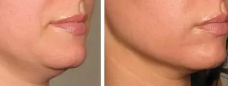 超声刀战胜法令纹原理,超声波祛法令纹有用吗