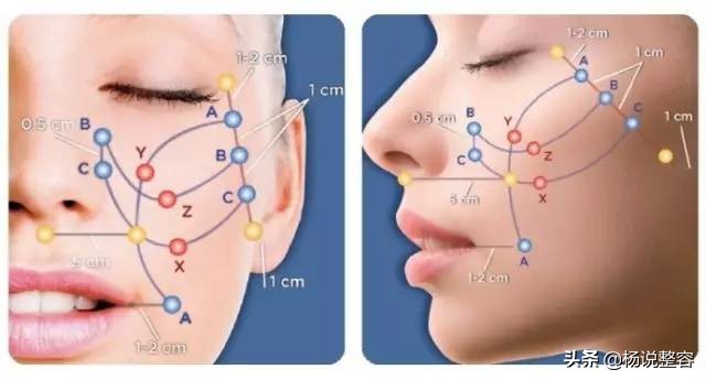500元的微针和5000元的微针,线雕的优点和缺点