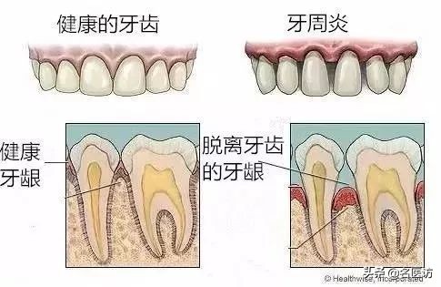 牙齿稀疏牙缝小怎么矫正效果最好,牙缝正畸后有概率还会恢复牙缝吗