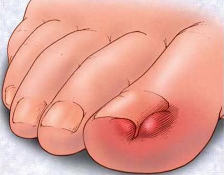 灰指甲加脚气加甲沟炎用什么泡脚,灰指甲脚气甲沟炎鸡眼挂什么科