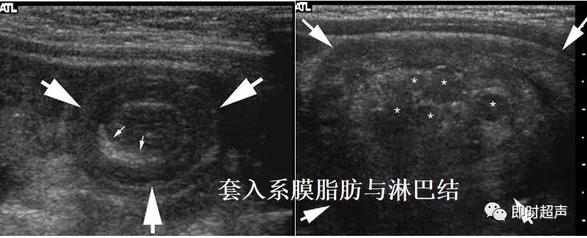 小儿消化道急症超声