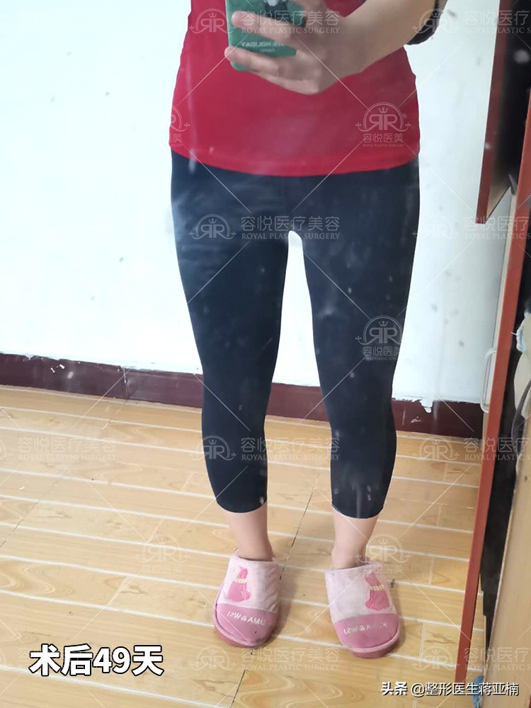 大腿吸脂后变胖,大腿吸脂拯救我的大粗腿
