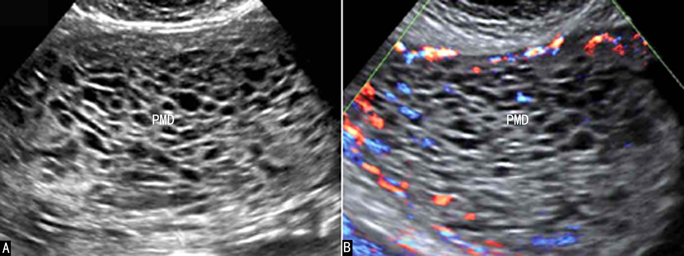 胎盘异常的超声表现,胎盘的异常超声