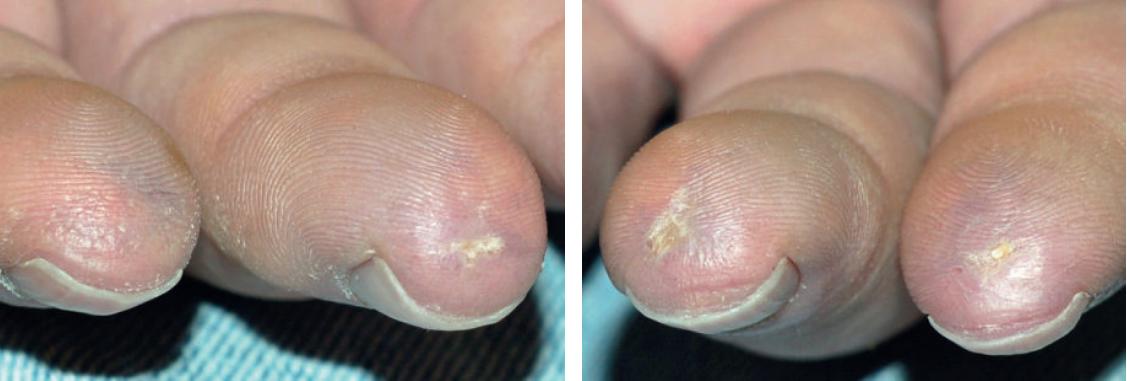 硬皮病是一种什么病,硬皮病由什么造成的