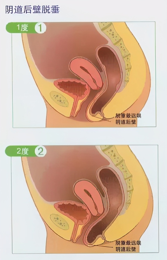 产后子宫脱垂膨出的症状怎么恢复,产后阴道膨出脱垂的症状