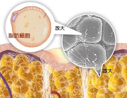 带你了解吸脂全过程,30秒带你了解大腿吸脂