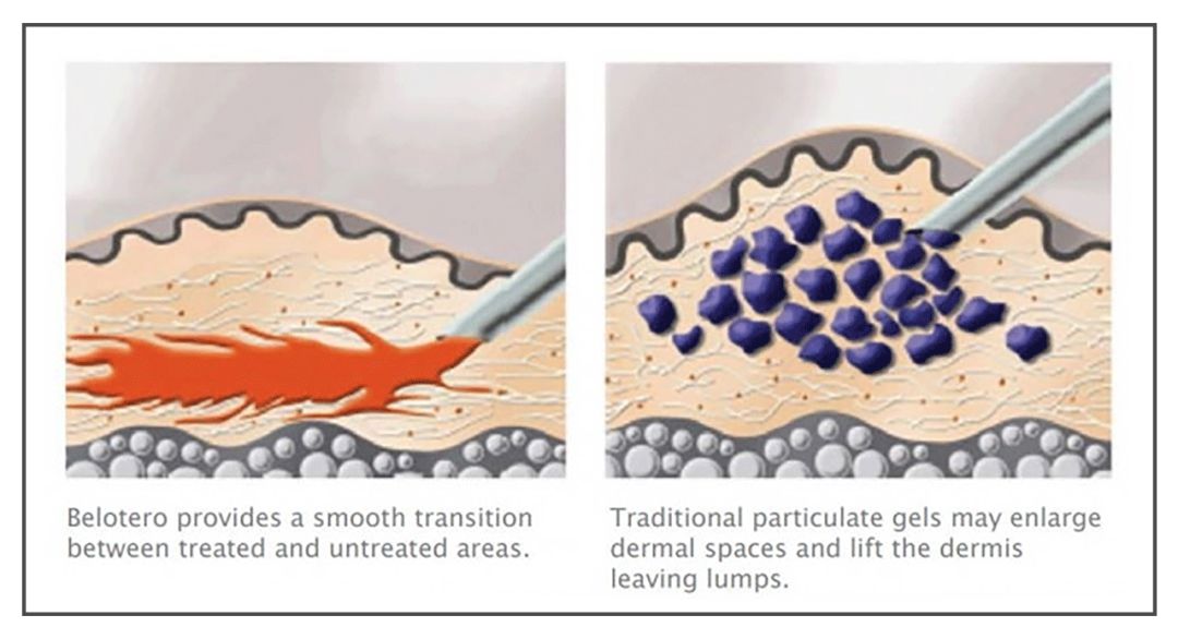 一次就能让黑眼圈消失的办法,一针下去瞬间没了黑眼圈