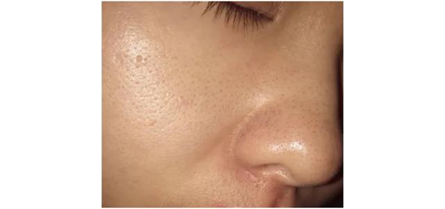 毛孔粗大满脸都是坑,毛孔粗大是糙皮病吗