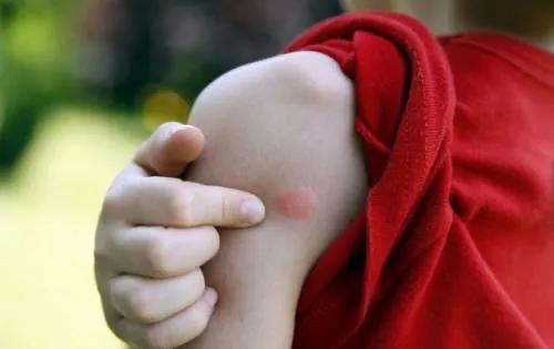 怎么防蚊子叮宝宝小技巧,夏天宝宝总被蚊子叮有什么好办法