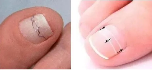 指甲老往肉里长化脓,指甲为什么一直往肉里长