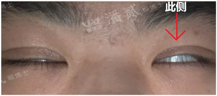 上睑下垂手术是不是永远闭不上眼,做了上睑下垂手术后怎么护理眼睛