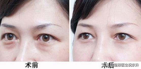 下眼皮松弛没有眼袋可以动手术吗,下眼皮内翻不做手术行不行