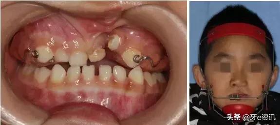 乳牙地包天会自动好吗,乳牙地包天矫正活动器