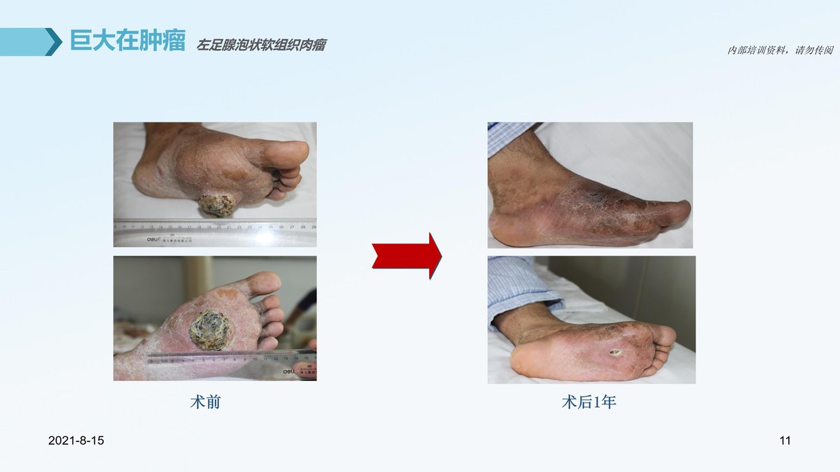 氩氦刀治疗肿瘤的医院,氩氦刀治疗肿瘤范围多大