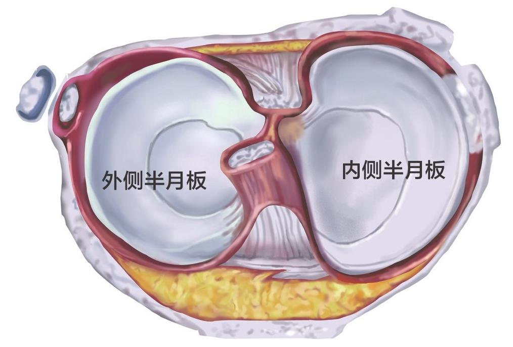 半月板撕裂要不要去修复,内侧半月板撕裂会切除多少半月板