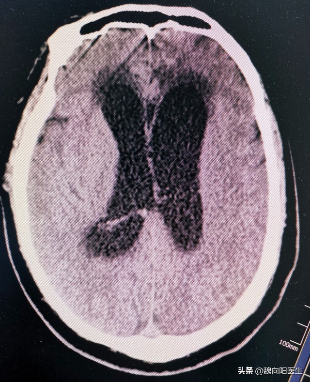 脑出血后积水能好吗,脑出血止住了脑水肿严重吗