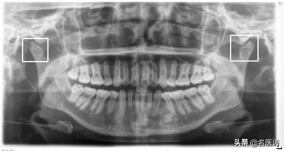 矫正科普|美人在骨不在皮，从神秘的牙片看牙齿和侧貌颜值