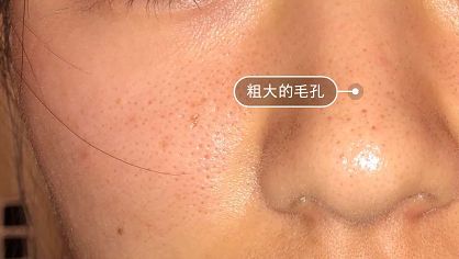 长黑头VS不长黑头差距这么大?精致女孩如何绕过黑头这道坎?