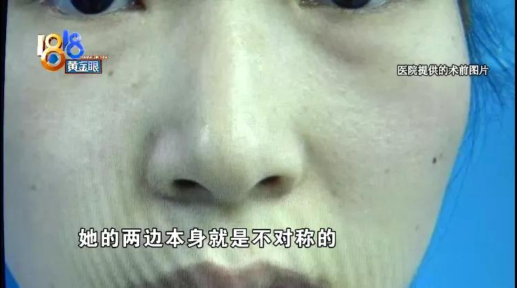 鼻子突然变暗变红,想要鼻子变高的方法