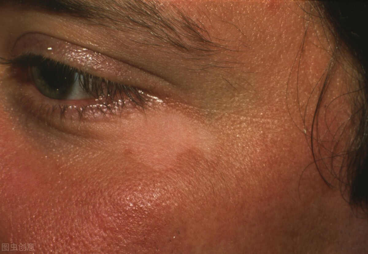 头上白癜风如何辨别,额头白癜风是怎么回事