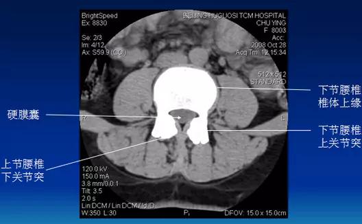 腰椎管狭窄的磁共振诊断标准,腰椎轻度退行性变化椎间盘膨出