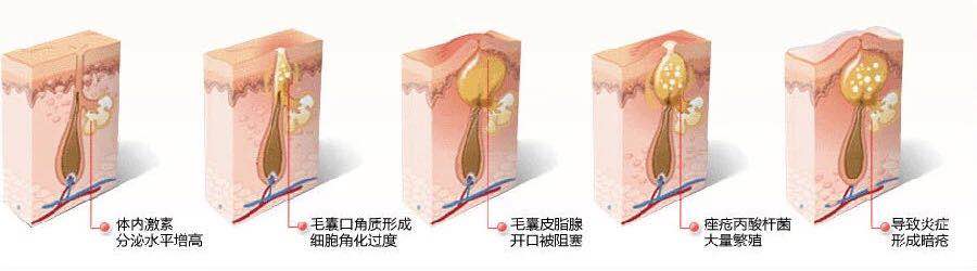 如何快速祛痘:痘痘分四个等级,你属于哪一级?
