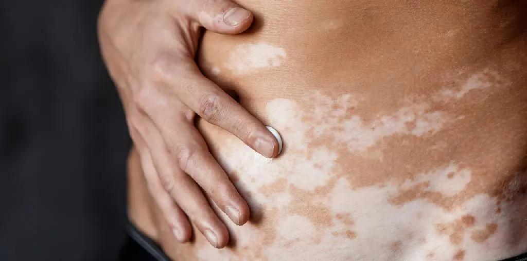 幼儿白癜风分几种类型啊,白癜风都有什么类型