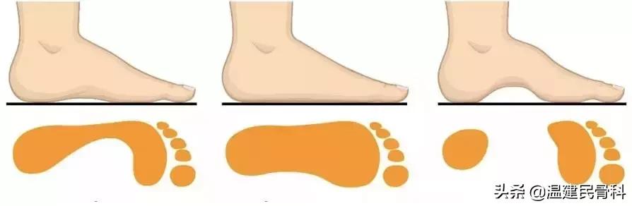 小孩扁平足已经影响走路了怎么办,多大孩子可以判断是扁平足