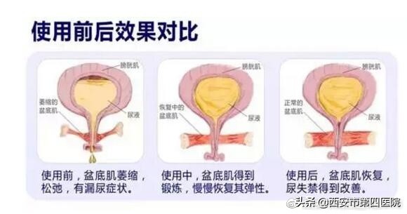 产后骨盆底肌训练方法,中医产后康复适宜技术培训