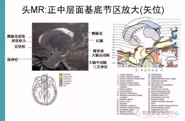 电子版头颅ct与mri断层解剖,头颅mri血管解剖与分段详解
